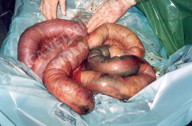 Necrosi da distensione del colon discendente costipato